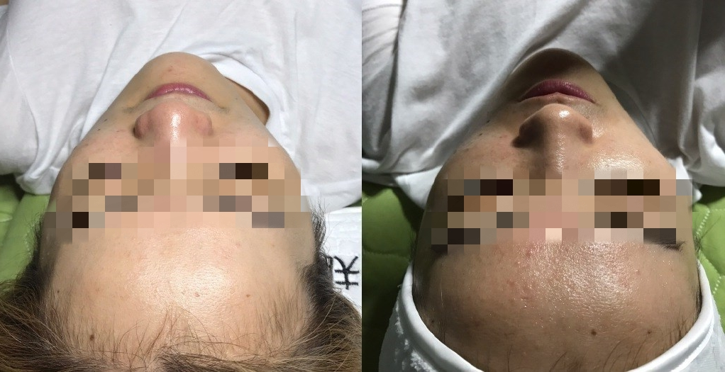 Tendge杏彩体育app官网入口
清水-软水机-洗脸对照